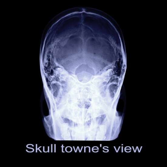 x-ray iam townes view